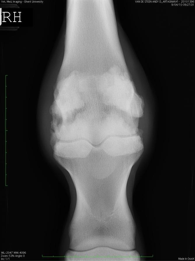 DEEL III: Klinisch belang van de sesambeenderen Fig. 17: Oude midbody fractuur van beide proximale sesambeenderen. Links: dorsoplantaire opname, rechts: lateromediaal. (Raes E.