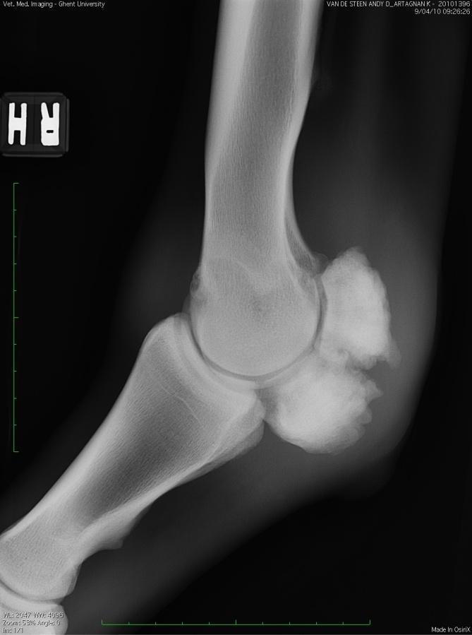 Enkel een chirurgische behandeling met interne fixatie (compressieschroef of cerclage) had een dergelijke nieuwbeenvorming kunnen voorkomen door de fragmenten bij elkaar te houden. 1.3.