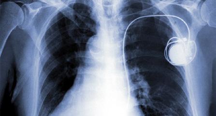 Leven met een pacemaker T +32(0)89 32 50 50 F +32(0)89 32 79 00 info@zol.
