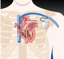 03 DE PACEMAKER (PM) Een pacemaker kan een hartritmeprobleem herkennen en zelf een elektrische impuls afgeven om uw hart weer regelmatig en op tijd te laten kloppen.