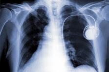 Daaraan vastgekoppeld bevinden zich één, twee of drie lange draden, de pacemakerelektroden. Een batterij zorgt ervoor dat de pacemaker jarenlang een elektrische impuls kan afgeven. 4.