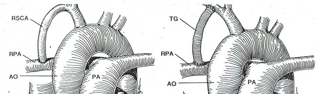 Palliatieve shunt s