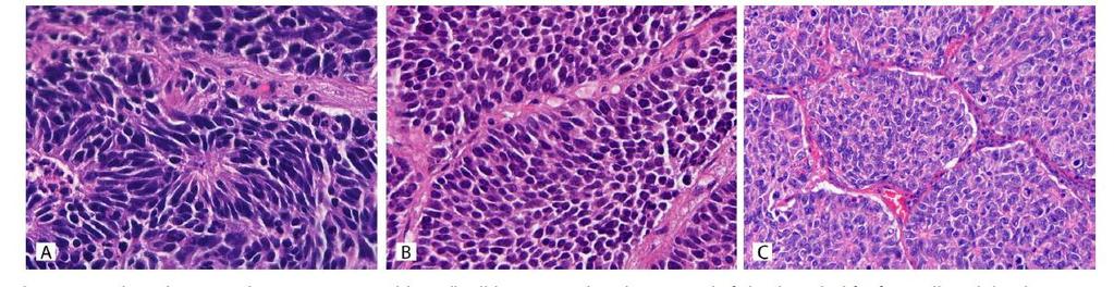 Criteria LCNEC overlappend met SCLC (tumor cel