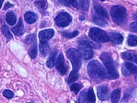 Achtergrond Tumor let/ DIPNECH Typisch carcinoid Atypisch