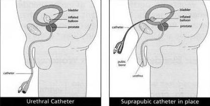 Verzorging FIXATIE VAN DE KATHETER De katheter kan niet zomaar uit uw blaas vallen. Aan het uiteinde van de katheter bevindt zich een ballonnetje wat na het inbrengen wordt gevuld met steriel water.