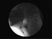 Retrospectieve Analyse Commando-resectie T2-4N0-2c oropharynx carcinoom 33 patiënten met lange follow-up Tenminste 15 maanden na behandeling (mediaan 21 maanden) Functie metingen Slikken X- Slikvideo