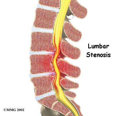 1. De spinale/lumbale stenose en de operatie Een spinale stenose is een vernauwing van het wervelkanaal.