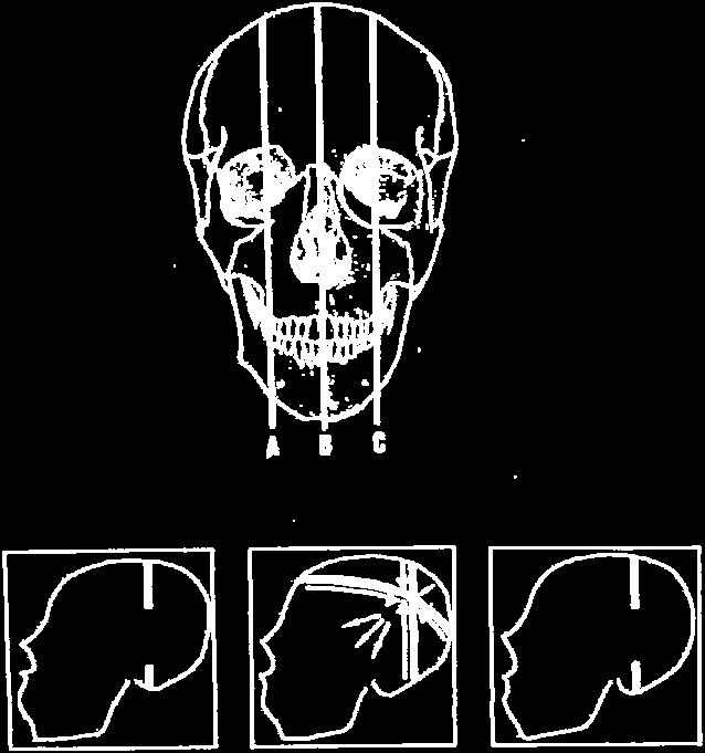 krachten. Figuur 8. Drie transversale doorsneden: A. Craniaal B. Mediana C.