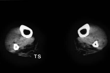 a b c Figuur 4. a) CT-scan van de onderbenen van een patiënt met Miyoshi myopathie. De m. triceps surae (TS) is beiderzijds vervet en atrofisch.