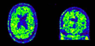 Negatieve amyloid PET-scan 5.