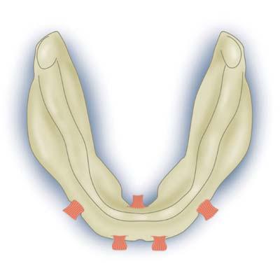 tot de aanhechting van de musculus genioglossus. ter hoogte van het trigonum retromolare. Daar bevindt zich een ondersnijding die uitnodigt om te worden gebruikt voor retentie van een onderprothese.