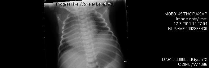 X-thorax en echo abdomen: diafragma