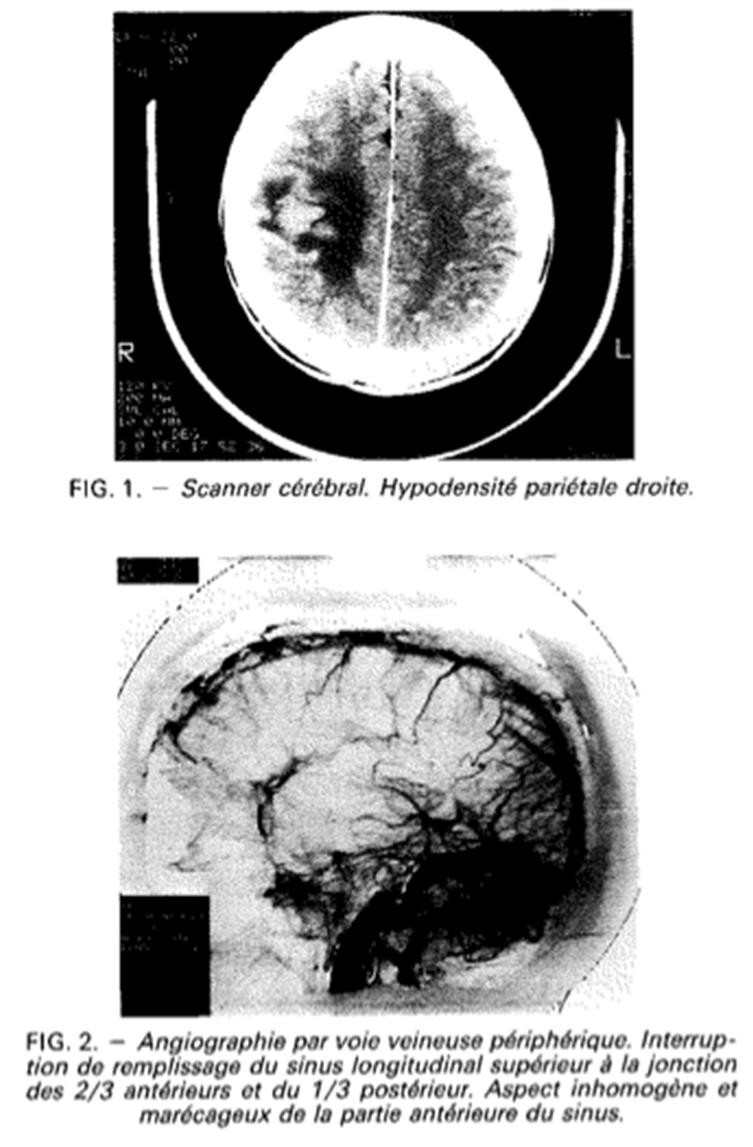 CT: Hypodense zone rechts
