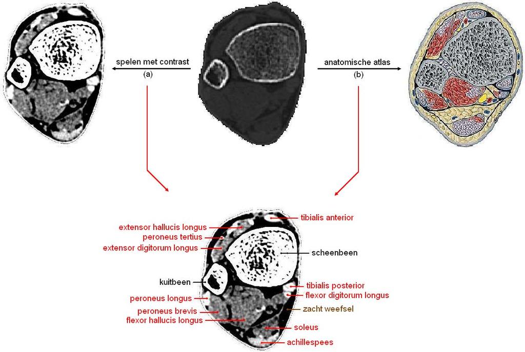 Hoofdstuk 7. Segmentatieprogramma s 89 Op deze scans kunnen de grootste anatomische entiteiten vastgesteld worden, de kleinere onderdelen van de voet zijn moeilijker waarneembaar.