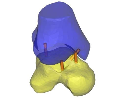 Hoofdstuk 7. Segmentatieprogramma s 98 7.2.3 Ligamenten en Pezen aanmaken met Mimics Vaak zijn de ligamenten en ook de pezen te klein om in de scans zichtbaar gemaakt te worden.