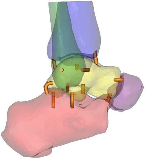 Om deze simulatieproblemen te voorkomen kan de nerve met behulp van Boolean Operations (Bijlage C.2) op maat afgesneden worden. Men trekt de aangrenzende botten dus af van het ligament (Figuur 7.13).