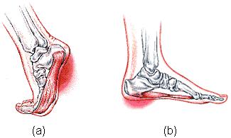 Hoofdstuk 3. Voetklachten 57 Artrose Bij artrose (slijtagereuma) treedt slijtage van het gewrichtskraakbeen op, hierdoor gaan bewegingen gepaard met veel pijn.