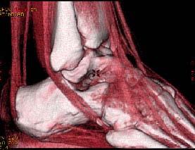 Door echter meerdere staven te gebruiken per ligament, kan de ruimtelijke spreiding van de aanhechting gesimuleerd worden (Figuur 6.3).