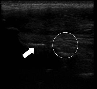 5.2. ECHOGRAFIE Op 08/06/2010 werden er echografische opnames gemaakt beide ellebogen (figuur 3-4). Rechter elleboog Fig.