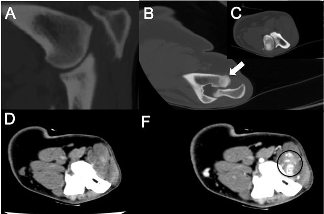 Fig. 6: CT-beelden van de rechter elleboog.
