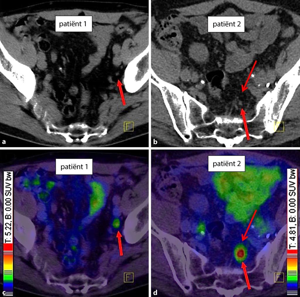 Figuur 1 Uitkomst van een CT-scan (a, b) en een 68 Ga-PSMA-PET/CT-scan (c, d) bij twee patiënten met een biochemisch recidief na in opzet curatieve radicale prostatectomie.