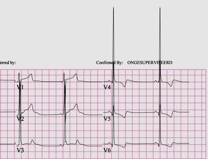 6 QRS morfologie pathologische Q golven? LVH / RVH?