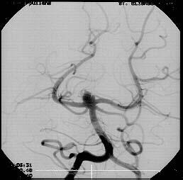 a b c Figuur 3. Coiling van een aneurysma met ballonreconstructie-techniek.