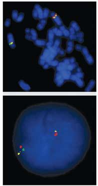 deletie FIP1L1 PDGFRA FIP1L1-PDGFRA normaal metafase normaal chromosoom 4 chromosoom 4 met deletie normaal deletie interfase A 