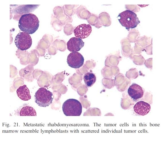 50 Immunofenotypering 1. Diagnose AL noodzakelijk A.