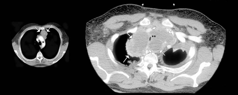 A B Figuur 2. (A) CT-scan van de thorax van een MEN1-patiënt op 42-jarige leeftijd. In het mediastinum is een afwijking zichtbaar (aangegeven met pijlen).