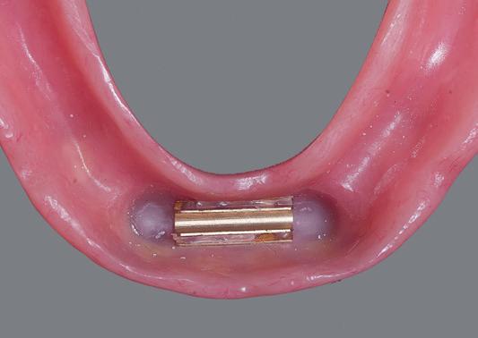 Het is altijd mogelijk om gedurende de behandeling enkele woorden met de implantoloog te wisselen. Via een opening in het tandvlees wordt het kaakbot zichtbaar.