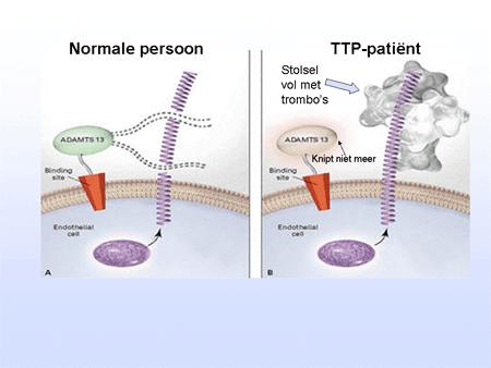 MAT : TTP HUS Pathofysiologisch verschil TTP : ADAMTS-13 deficiëntie *verworven antilichamen * genetische mutatie HUS: hyperactivatie