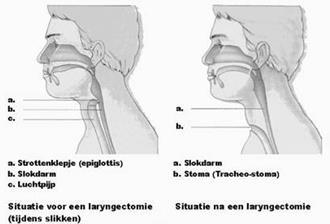 Protocollen Voorbehouden, Risicovolle en Overige handelingen Tracheacanule 3 Tracheotomie en tracheostoma Een tracheotomie is het openen van de luchtweg door het insnijden van enkele kraakbeenringen