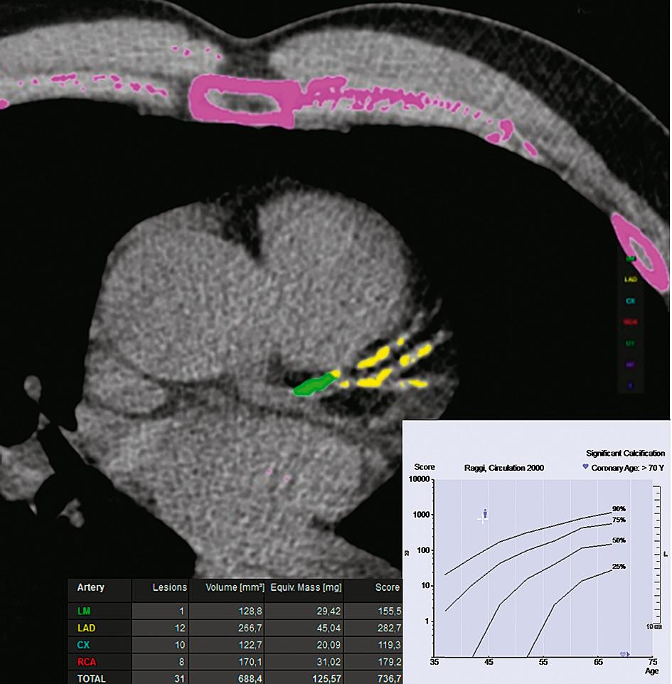 FIGUUR 1 Coronaire-arterie-calcium-CT-scan bij een asymptomatische 45-jarige man. Calcificaties zijn zichtbaar in de distale hoofdstam (groen) en de R. interventricularis anterior van de linker A.