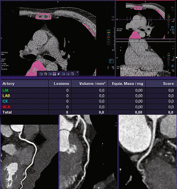 a b FIGUUR 2 (a) Coronaire-arterie-calcium-CT-scan bij een 61-jarige vrouw met niet-angineuze thoracale klachten. Radiodense structuren, zoals kalk en botten, zijn weergegeven in roze.