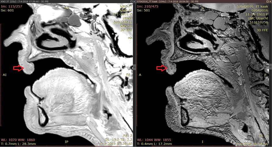 gezien werden in de MRI beelden. De beoordeling van de artefacten is telkens door dezelfde twee onderzoekers gedaan.