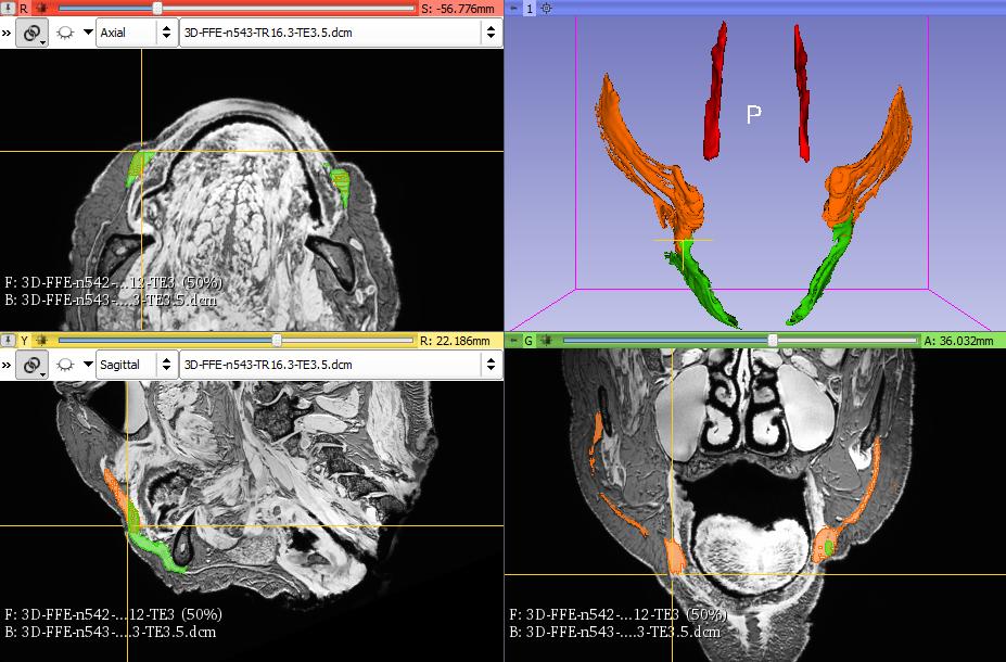 Voor de m. nasalis, m. depressor anguli oris, m. zygomaticus major en minor wordt Scan 8 gebruikt voor de segmentatie. Voor de m. orbicularis wordt Scan 7 en voor de m.