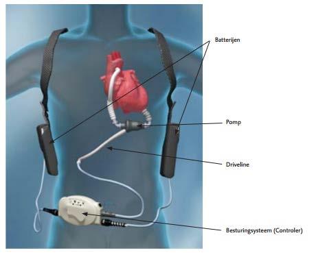 vwz: LVAD Neemt pompfunctie linker ventrikel over Overbrugging