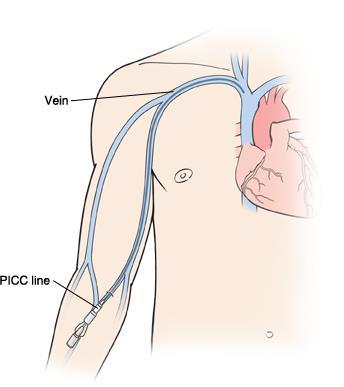 Waarom krijgt u een PICC-lijn? Voor de behandeling van uw ziekte krijgt u regelmatig medicijnen en/of bloedproducten via een infuus.