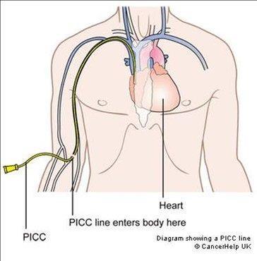 Als het inbrengen van een infuus veel problemen oplevert en/of u moet langere tijd chemotherapie of andere intraveneuze medicatie krijgen dan kan een PICC-lijn een mogelijke oplossing bieden.