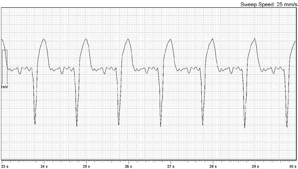 Oversensing VVI