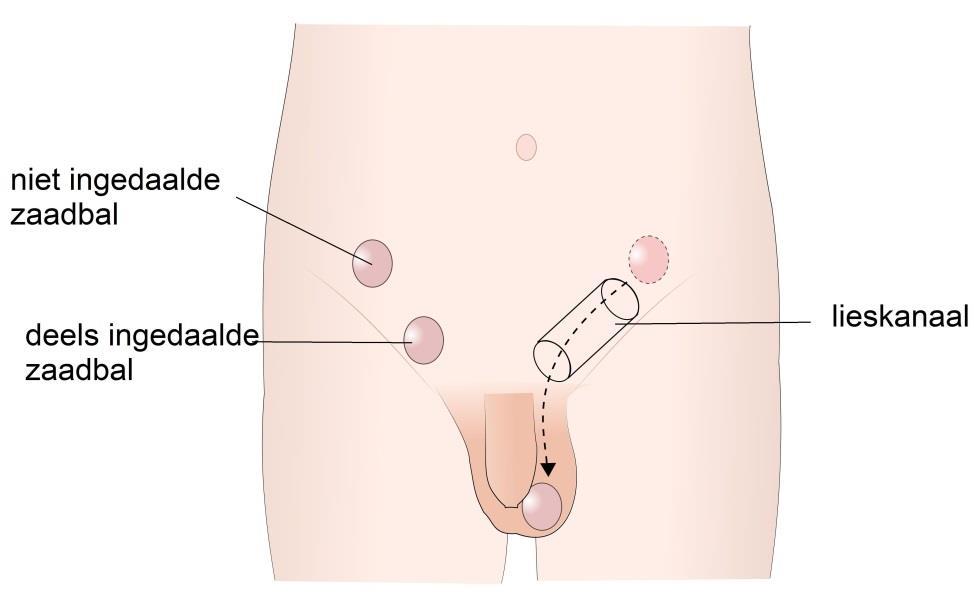 Rechts de zaadbal die via het lieskanaal indaalt. Links de niet of deels ingedaalde zaadbal.