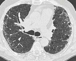 Drs. Esther Nossent is sinds 2014 longarts en werkt in het VU Medisch Centrum te Amsterdam. Haar aandachtsgebieden zijn pulmonale hypertensie (PH) en interstitiële longziekten.