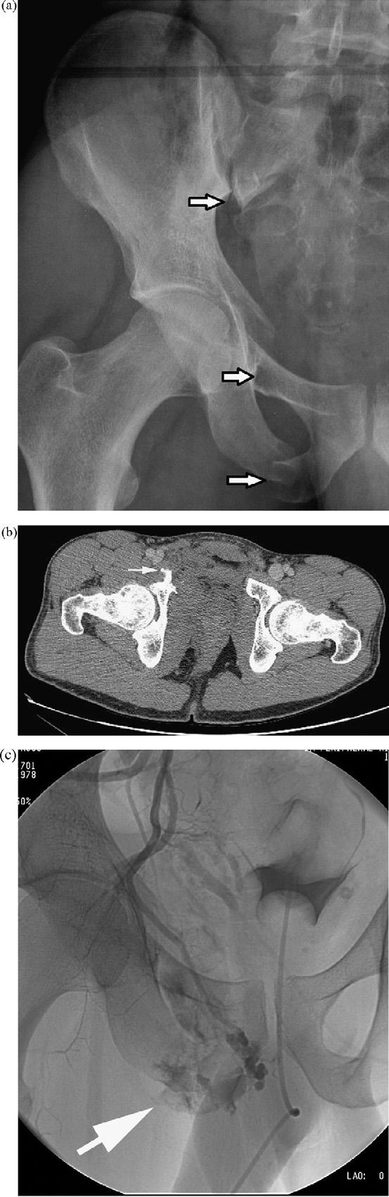 Belangrijkste risico - bloeding Mortaliteit tot 60% in geval van hemodynamische instabiliteit Bloeding: arterieel, veneus of uit spongieus bone Aangedane arterie gerelateerd aan plaats fractuur used