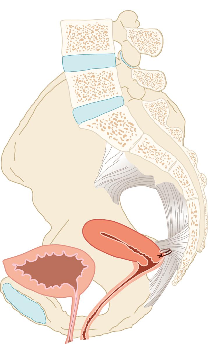 fothergill-procedure werd vergeleken met een hysterectomie (zie tabel 1). 17-19 Een Nederlandse studie liet zien dat er was in anatomische uitkomst en subjectieve uitkomst na 1 jaar follow-up.