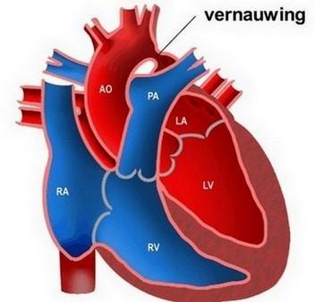 Coarctatio aortae Bloeddrukverschil tussen arteriae brachiales en/of tussen arteriae