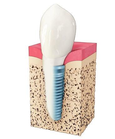 Implantaten bieden veel voordelen Wat is een implantaat? Een implantaat werkt als de tandwortel van uw nieuwe tand.