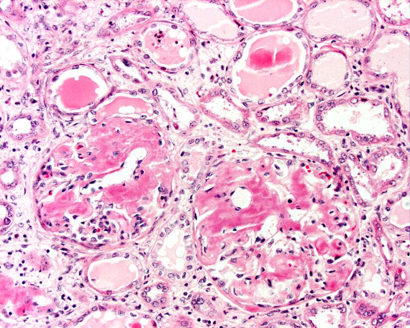 Monoclonal Immunoglobulin Deposi3on Diseases (MIDD) Klinisch: neerslag Ig in viscerale en zachte weefsels De meest frequent voorkomende vorm is 1 amyloïdose, waarbij (meestal) lichte ketens neerslaan