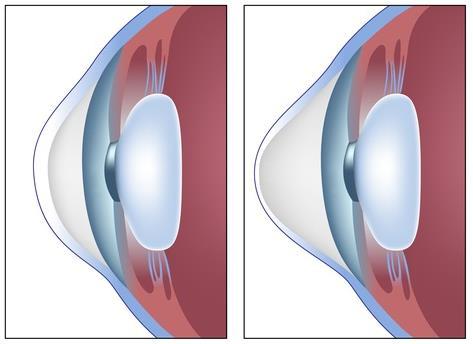 De lichtstralen worden naar elkaar toe gebogen zodat er een scherp beeld ontstaat op het netvlies achter in het oog. U heeft een oogaandoening die keratoconus heet.