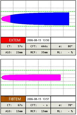 FIBTEM EXTEM met toevoeging van cytochalasine D (afbraak cytoskelet van